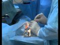 Уникальную операцию по пересадке эндотелия роговицы проводят в столичном Институте Гельмгольца