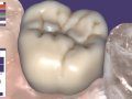 ChairsideCAD – уникальное решение от exocad для реставрации дефектов зубов